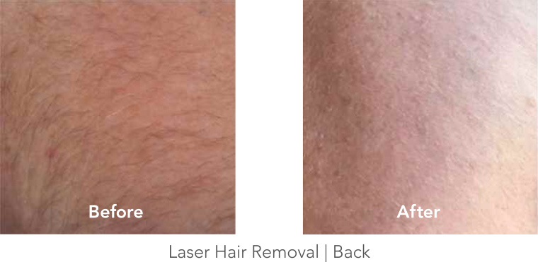 Laser Hair Removal - Back