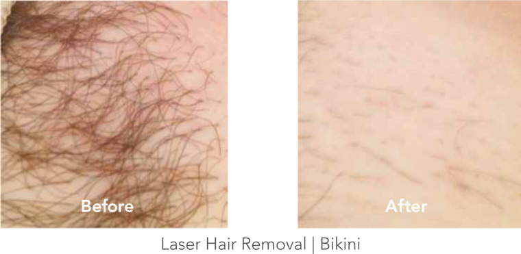 Laser Hair Removal - Bikini