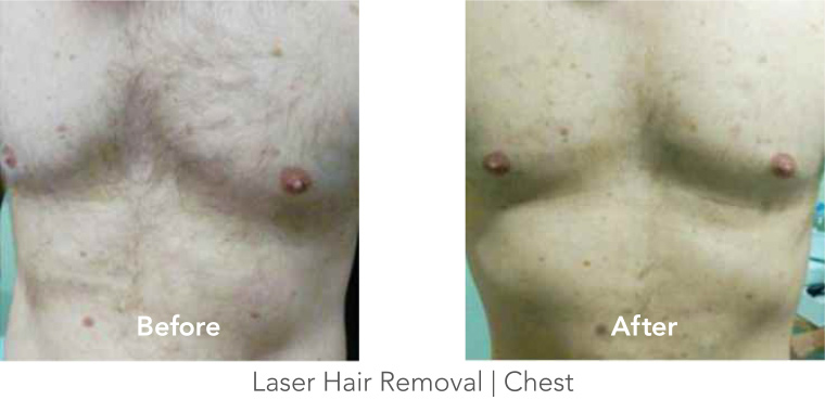 Laser Hair Removal - Chest