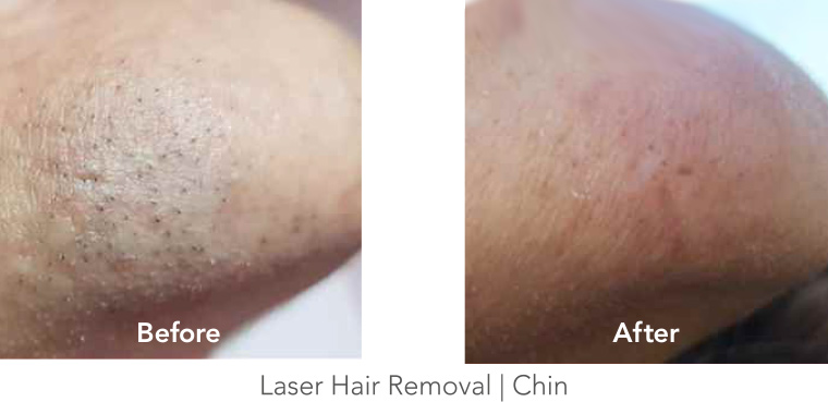 Laser Hair Removal - Chin